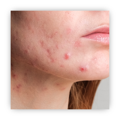 Daily Acne Control Bundle