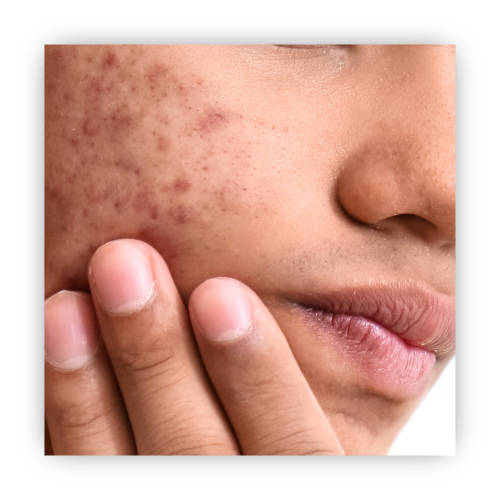 ACNE CLEAR KIT